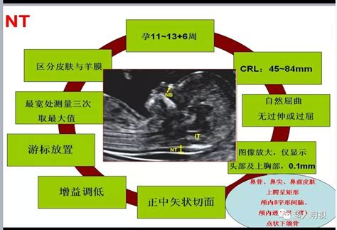 A Comprehensive Guide to NT Scan During Pregnancy in 2023