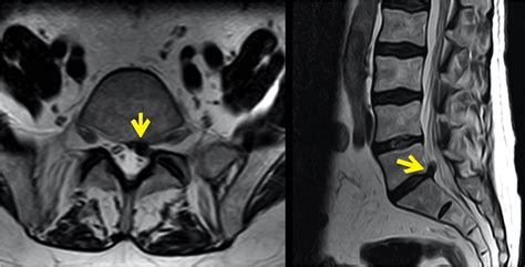 Is Thecal Sac Indentation Serious? Everything You Need to Know - Spine Info