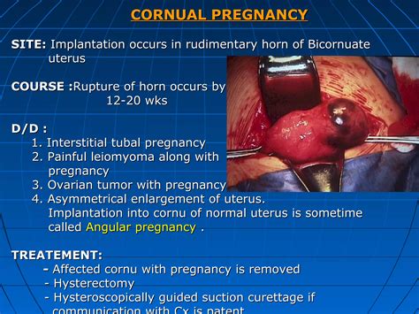 Ectopic pregnancy | PPT