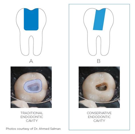 TruNatomy Endodontic Files | Dentsply Sirona India