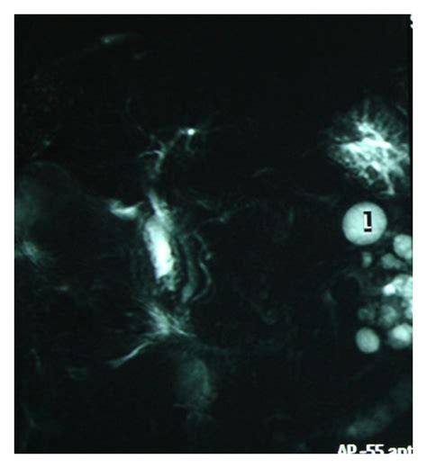 Image result for MRCP Biliary Tree