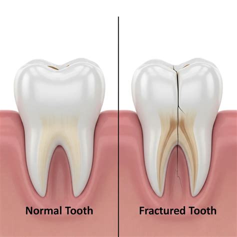 Open Vs Closed Tooth Fracture