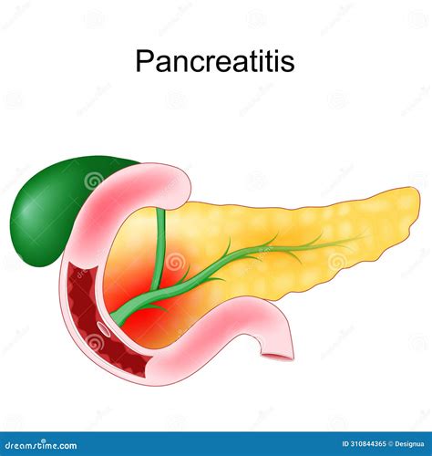 Acute Pancreatitis. Duodenum, Gallbladder and Pancreas Stock Vector ...
