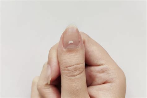 Here's What It Means if You Have White Spots on Your Nails | The Healthy