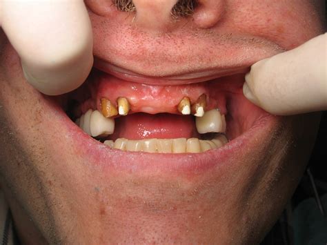 Front Bridge Teeth Types Of Dental Bridges: What Type Is Best For Me?