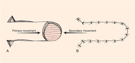 ADVANCEMENT FLAPS - Clinical Tree