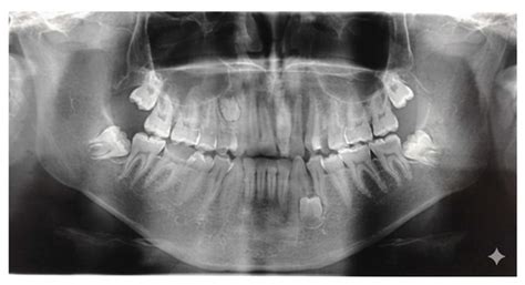 Impaction Predictors and Diagnostic Performance of CBCT Versus ...