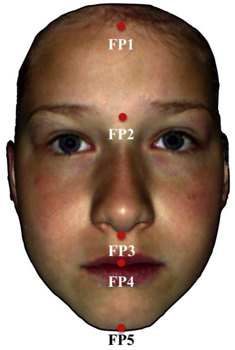 Children with Fetal Alcohol Syndrome (FAS): 3D-Analysis of Palatal Depth and 3D-Metric Facial Length