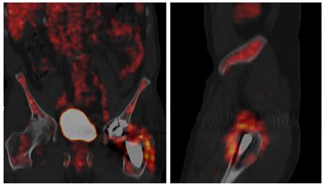Imaging in Periprosthetic Joint Infection Diagnosis: A Comprehensive Review
