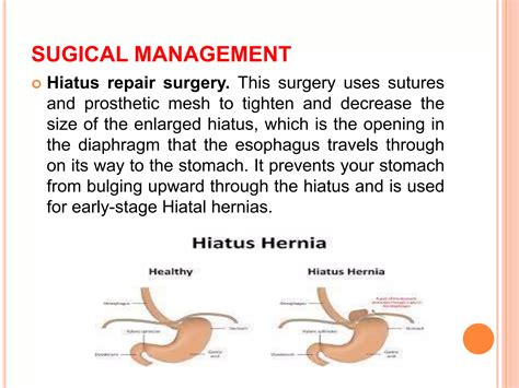 Hiatal Hernia.pptx