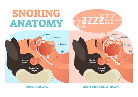 What Causes Snoring