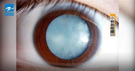 每天可樂當水喝！15歲男「眼睛變淡藍色」慘失明 醫搖頭：不可逆 | ETtoday大陸新聞 | ETtoday新聞雲