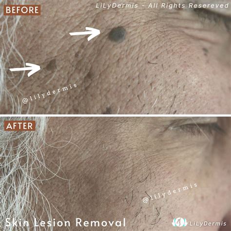 Seborrheic Keratosis Removal | LiLyDermis | Calgary