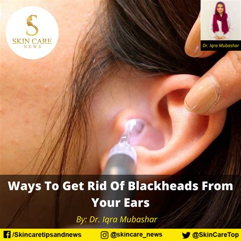 Ways To Get Rid Of Blackheads From Your Ears