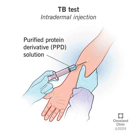 Image result for PPD Procedure