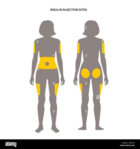 Insulin injection sites, illustration Stock Photo - Alamy