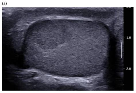 Leydig Cell Tumors of the Testis: An Update of the Imaging ...