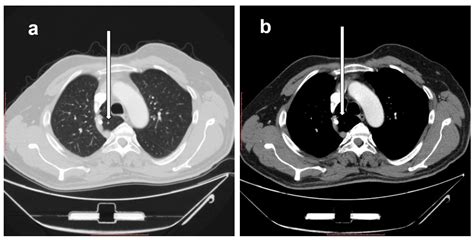 Azygos Vein Ct Corona