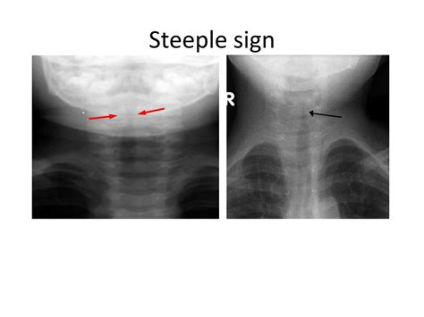 PPT - Stridor in Children PowerPoint Presentation, free download - ID ...