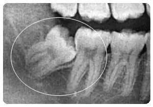 请牙医帮我看看这个X片，我这个智齿和埋伏牙该拔吗？哪颗拔掉呢。_百度知道