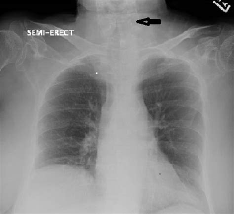 Uncommon presentation of a common disease: influenza A presenting as ...