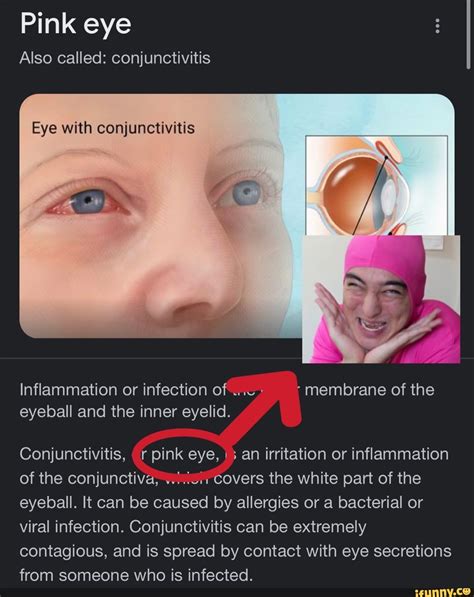 Pink eye Also called: conjunctivitis Eye with conjunctivitis Inflammation or infection of ...