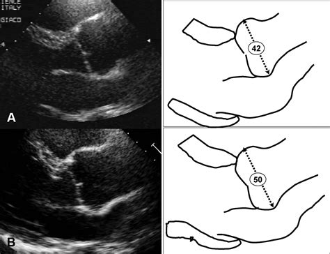 Prevalence and Clinical Significance of Aortic Root Dilation in Highly ...