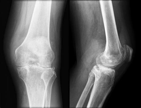 A Sixty-two-Year-Old Man with Marked Knee Pain - JBJS Image Quiz