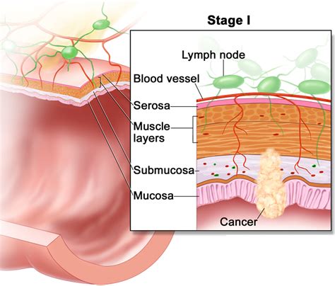 Colon Cancer Causes, Signs, Symptoms, Stages, Screening & Treatment