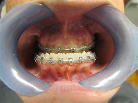 Plastic Surgery Jaw Reconstruction at Abby Folingsby blog