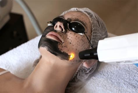 Carbon-Laser-Peeling - Beauty Lounge Weiden