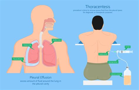 Best Lung Specialist for Pleural Effusions and Empyema | Mumbai