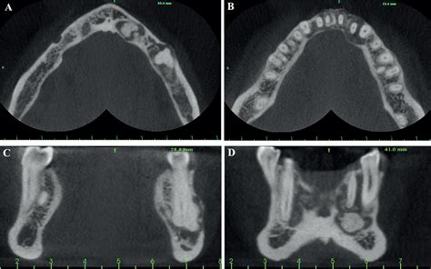 Cemento Osseous Dysplasia