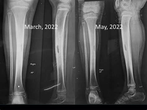 Chronic Recurrent Multifocal Osteomyelitis - a care report.pptx