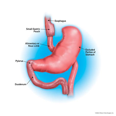 Lista 91+ Foto Bypass Gastrico Antes Y Despues Piel Alta Definición ...