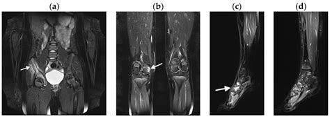 Whole-Body MRI at Initial Presentation of Chronic Recurrent Multifocal Osteomyelitis, Juvenile ...
