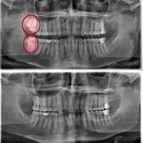 Extracted Wisdom Tooth 的图像结果