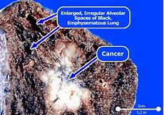 lung cancer photo all about asbestos smokers lungs pictures smokers lungs vs healthy lungs lung cancer photo all about asbestos smokers lungs pictures smokers lungs vs healthy lungs