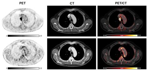 Induction of Arterial Inflammation by Immune Checkpoint Inhibitor ...