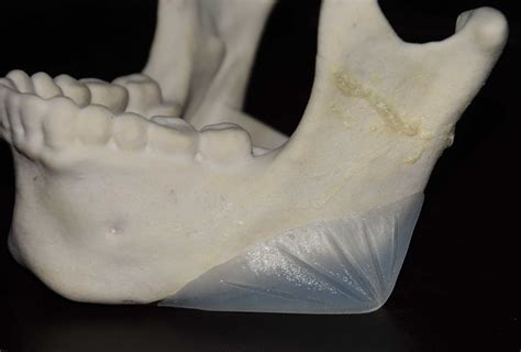 Plastic Surgery Case Study - Female Jaw Angle Implants for a More Defined Jawline - Explore ...