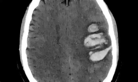 Nitroglycerin not to be given to patients with suspected stroke: LANCET