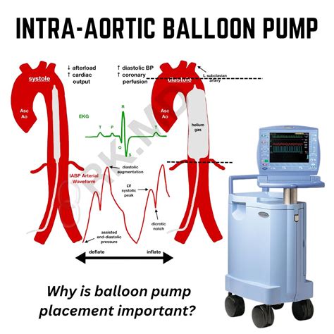 Intra-aortic balloon pump: how it works and complications | Dorcas ...