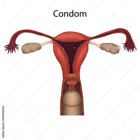 Image result for How Does a Condom Work