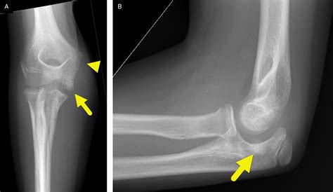 Medial Epicondyle Fracture