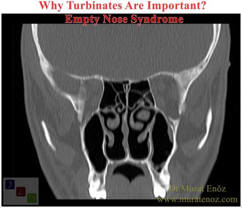 Why Turbinates Are Important? - Empty Nose Syndrome