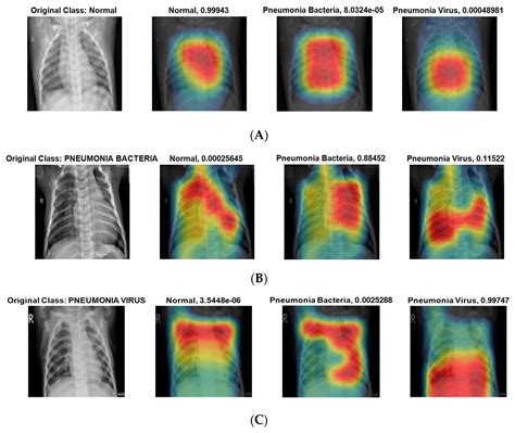PneumoniaNet: Automated Detection and Classification of Pediatric ...