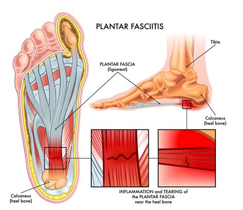 Dry Needling for Plantar Fasciitis — Morningside Acupuncture NYC