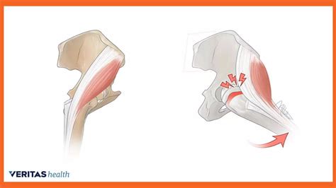 How to Perform Hip Ultrasound 的图像结果