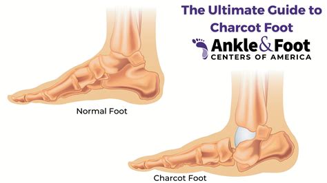 The Ultimate Guide to Charcot Foot | Richard Kaufman, DPM