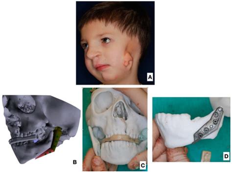 Use of a Fibula Free Flap for Mandibular Reconstruction in Severe ...